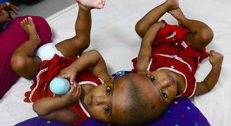 Em casos raros, gêmeos idênticos podem nascer com a pele e com certos órgãos internos ligados(foto: Munir Uz Zaman/ AFP - 25/7/2017) Em casos raros, gêmeos idênticos podem nascer com a pele e com certos órgãos internos ligados(foto: Munir Uz Zaman/ AFP - 25/7/2017)