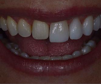 Na foto, a metade direita dos dentes está com lentes de contato, a metade esquerda está sem lentes(foto: Regis Melo/Reprodução) Na foto, a metade direita dos dentes está com lentes de contato, a metade esquerda está sem lentes(foto: Regis Melo/Reprodução)