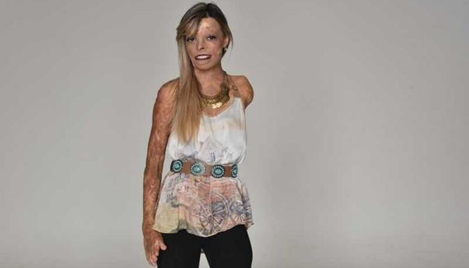 Vítima de um acidente que queimou o seu corpo e a fez perder um dos braços, Ananda não se deixa abalar pelas marcas(foto: Zuleika de Souza/CBD.A. Press) Vítima de um acidente que queimou o seu corpo e a fez perder um dos braços, Ananda não se deixa abalar pelas marcas(foto: Zuleika de Souza/CBD.A. Press)
