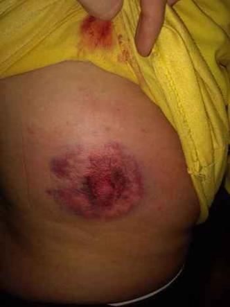 Marca de tiro no corpo de agente do Detran(foto: Divulgação) Marca de tiro no corpo de agente do Detran(foto: Divulgação)