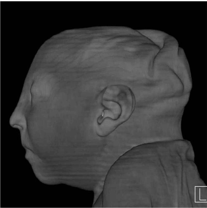 Tomografia computadorizada de uma criança nascida após 38 semanas de gestação. A mãe do bebê foi infectada pelo zika vírus, transmitido pelo mosquito Aedes aegypti(foto: Radiological Society of North America/Divulgação) Tomografia computadorizada de uma criança nascida após 38 semanas de gestação. A mãe do bebê foi infectada pelo zika vírus, transmitido pelo mosquito Aedes aegypti(foto: Radiological Society of North America/Divulgação)