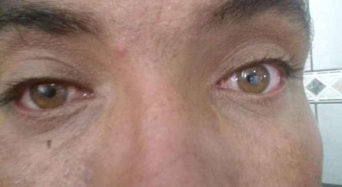 Régis mostra os olhos avermelhados pela conjuntivite: quando os primeiros sintomas aparecem, o ideal é procurar um oftalmologista(foto: Arquivo pessoal) Régis mostra os olhos avermelhados pela conjuntivite: quando os primeiros sintomas aparecem, o ideal é procurar um oftalmologista(foto: Arquivo pessoal)