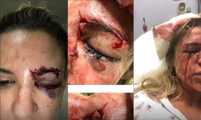 A artista publicou imagens do rosto machucado no Instagram(foto: Reprodução/Instagram) A artista publicou imagens do rosto machucado no Instagram(foto: Reprodução/Instagram)