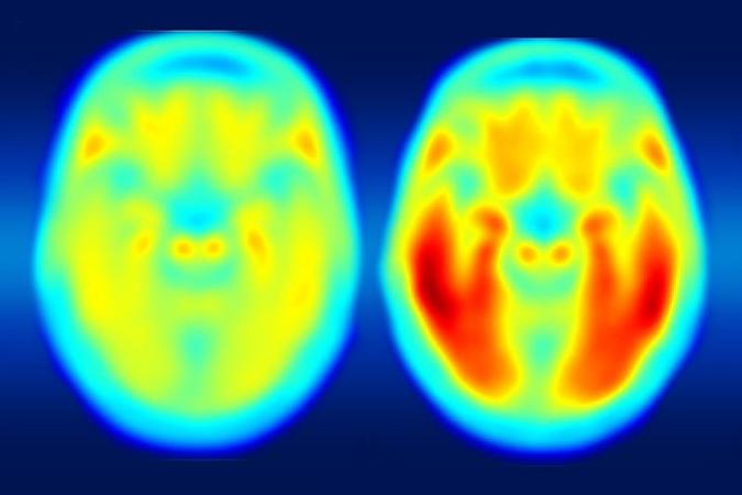 Ressonância magnética busca sinais precoces do Alzheimer(foto: Matthew R. Brier/Divulgação) Ressonância magnética busca sinais precoces do Alzheimer(foto: Matthew R. Brier/Divulgação)