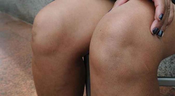 Postura mais indicada é a prevenção: cuidados com as articulações, como as do joelho(foto: Carlos Moura/CB/D.A Press) Postura mais indicada é a prevenção: cuidados com as articulações, como as do joelho(foto: Carlos Moura/CB/D.A Press)