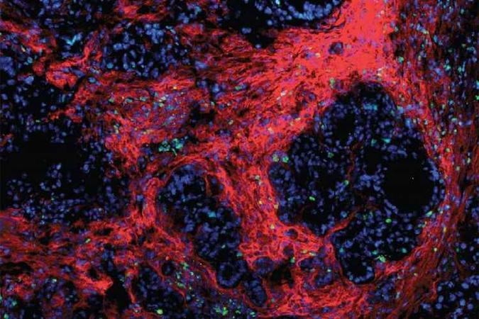Microambiente de um tumor de pâncreas em um dos animais do estudo: células verdes, cancerosas, foram atacadas pela substância(foto: DeNardo Lab/Divulgação) Microambiente de um tumor de pâncreas em um dos animais do estudo: células verdes, cancerosas, foram atacadas pela substância(foto: DeNardo Lab/Divulgação)