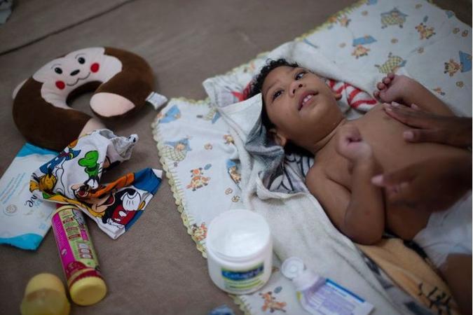 As malformações fetais, como a microcefalia, acometem 5% dos filhos de grávidas infectadas pelo vírus(foto: AFP / Mauro PIMENTEL) As malformações fetais, como a microcefalia, acometem 5% dos filhos de grávidas infectadas pelo vírus(foto: AFP / Mauro PIMENTEL)