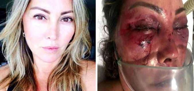 A empresária Elaine Perez Caparroz, antes e depois das agressões(foto: Reprodução/TV Globo) A empresária Elaine Perez Caparroz, antes e depois das agressões(foto: Reprodução/TV Globo)
