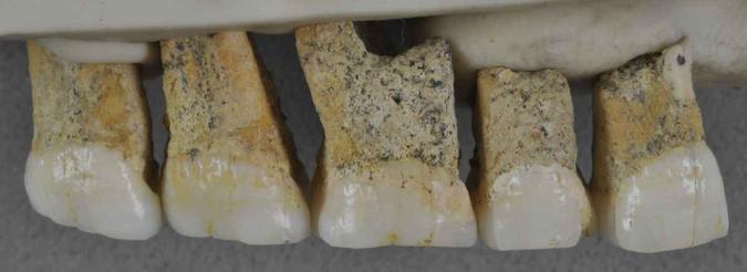 Dentes do Homo luzonensis encontrados na Caverna de Callao: no local havia ainda fósseis de pés e mãos (foto: Callao Cave Archaeology Project/Divulgação ) Dentes do Homo luzonensis encontrados na Caverna de Callao: no local havia ainda fósseis de pés e mãos (foto: Callao Cave Archaeology Project/Divulgação )