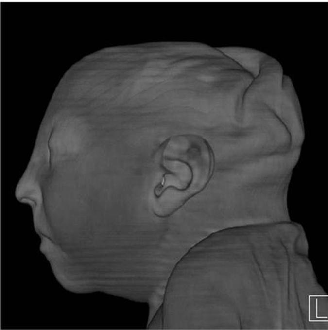 Tomografia de criança cuja mãe foi infectada pelo zika durante a gestação(foto: Radiological Society of North America/Divulgação) Tomografia de criança cuja mãe foi infectada pelo zika durante a gestação(foto: Radiological Society of North America/Divulgação)