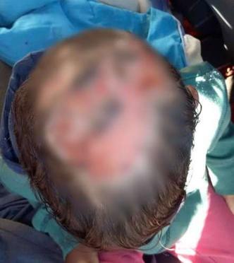 Menino está com o couro cabeludo bastante ferido(foto: Reprodução/Redes Sociais) Menino está com o couro cabeludo bastante ferido(foto: Reprodução/Redes Sociais)