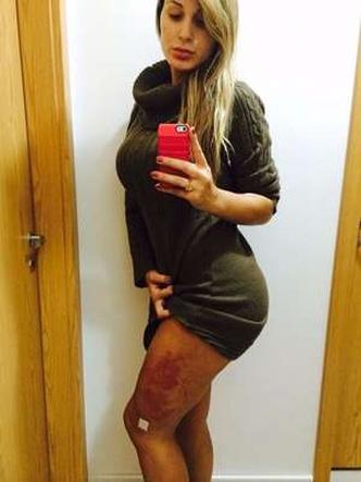 Andressa Urach Antes E Depois Das Plasticas Medicos Defendem Que Hidrogel Seja Banido E Analisado Pelo Cfm