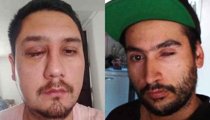 Ronald e Nicolas: alvos de carabineiros, os dois precisam se adaptar à vida sem um dos olhos(foto: Arquivo pessoal) Ronald e Nicolas: alvos de carabineiros, os dois precisam se adaptar à vida sem um dos olhos(foto: Arquivo pessoal)