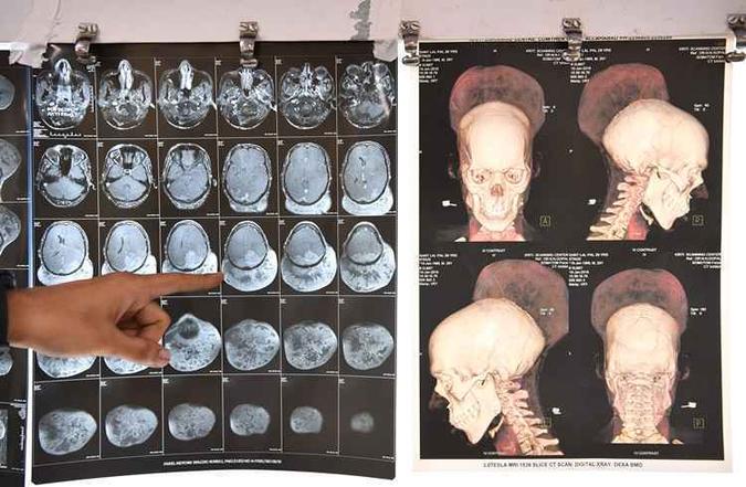 Após a operação, foi observado que o tumor tinha 1,87 kg, o mais pesado já extraído de um paciente que sobreviveu, indicou um comunicado do hospital(foto: Indranil Mukherjee / AFP ) Após a operação, foi observado que o tumor tinha 1,87 kg, o mais pesado já extraído de um paciente que sobreviveu, indicou um comunicado do hospital(foto: Indranil Mukherjee / AFP )