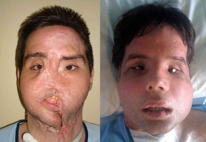 Antes e depois: Oscar, um homem que ficou desfigurado após um acidente e foi a primeira pessoa a receber uma transplante completo de face, em 2010. A operação foi feita no Hospital Vall d'Hebron, em Barcelona.AFP Antes e depois: Oscar, um homem que ficou desfigurado após um acidente e foi a primeira pessoa a receber uma transplante completo de face, em 2010. A operação foi feita no Hospital Vall d'Hebron, em Barcelona.AFP