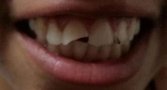 A adolescente teve dois dentes quebrados, o maxilar deslocado e machucou o tornozelo(foto: Arquivo pessoal) A adolescente teve dois dentes quebrados, o maxilar deslocado e machucou o tornozelo(foto: Arquivo pessoal)